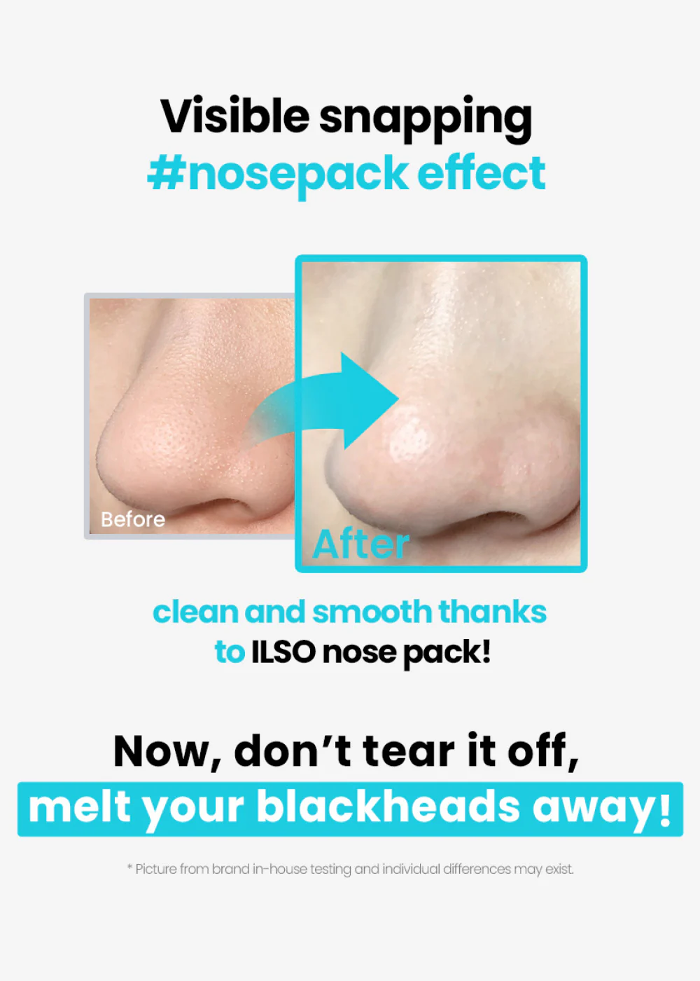 ilso Natural Mild Clear Nose Pack - Mrs Treak